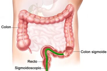 Cancer de colon