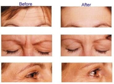 Aplicación de Botox Dra. Castelblanque