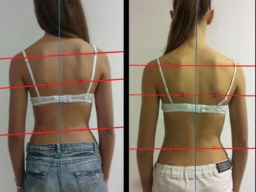 Principal Escoliosos