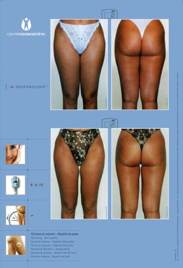 Centre Fisiobioestètic – antes y después