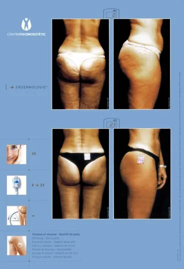 Centre Fisiobioestètic – antes y después