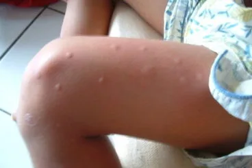 Picaduras del mosquito tigre