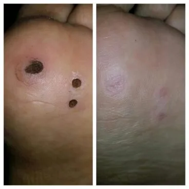 antes y después clínica estévez