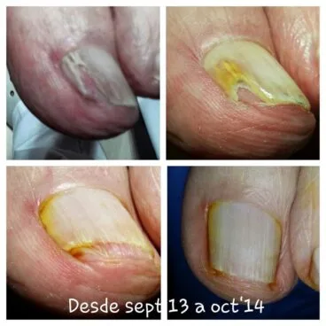 antes y después hongos