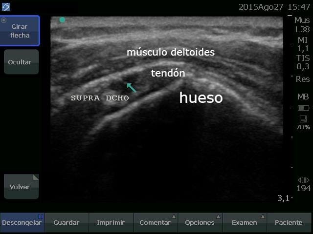 Descubre el nuevo equipo ecográfico de Clínica Kines para la valoración de lesiones 1 Lesión en tendón