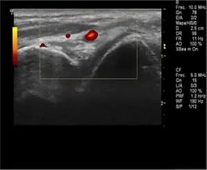 Control ecográfico de un esguince