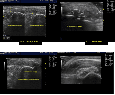 ¿Cuál es la diferencia entre tendinitis y una tendinosis? 1 Tendón de aquiles