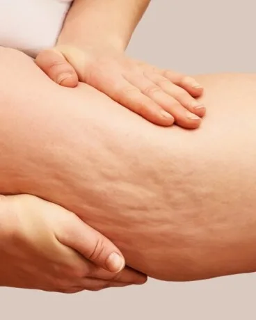 Tratamiento eficaz para la eliminación de celulitis y grasa localizada