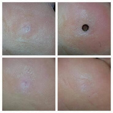 Láser S30 Podylas Helomas en Clínica Podológica Estevez