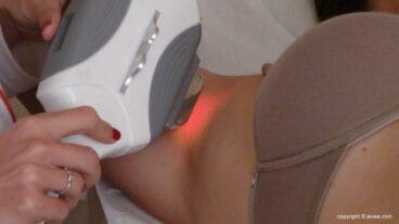 Policlínica Cume – depilación Láser