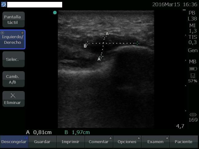 Historia de un caso de problemática de la fascia plantar en Clínica Kynes