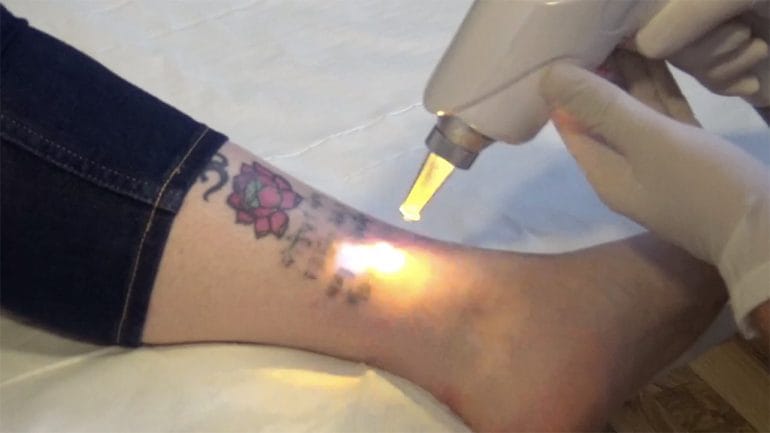 Quitatutattoo láser