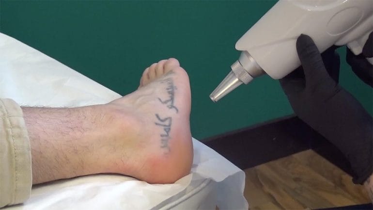Quitatutattoo eliminación tatuajes