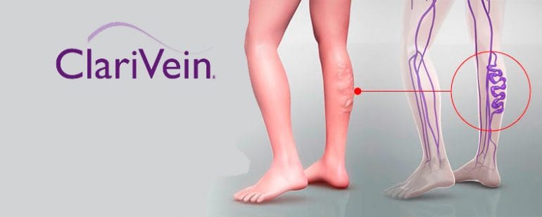 Clariven para varices Clínica Estética Castelblanque