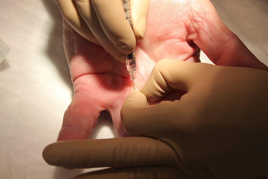 inyeccion de colagenasa