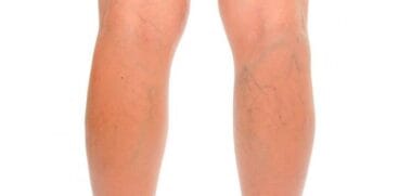 tratamiento varices hla san carlos