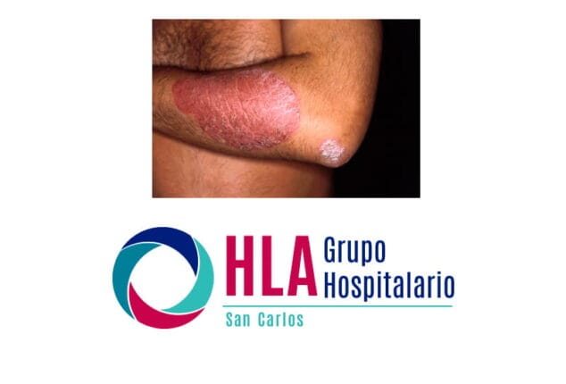 psoriasis hla san carlos