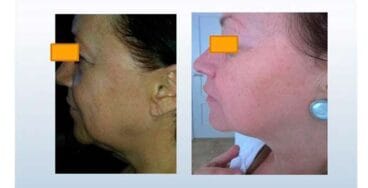 Antes y después del tratamiento Dorita e inma estilistas