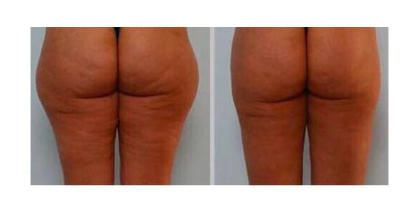 antes y despues lifting dorita e inma estilistas