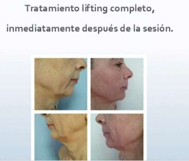 Tratamiento lifting completo Dorita e Inma Estilistas
