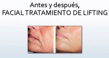 Tratamiento lifting Dorita e Inma Estilistas