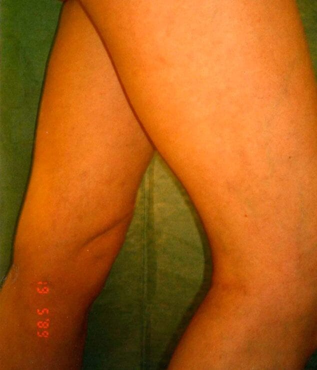 despues del tratamiento policlinica cume