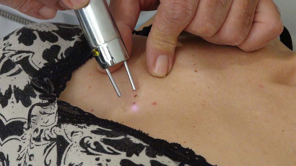 puntos rubi policlinica cume