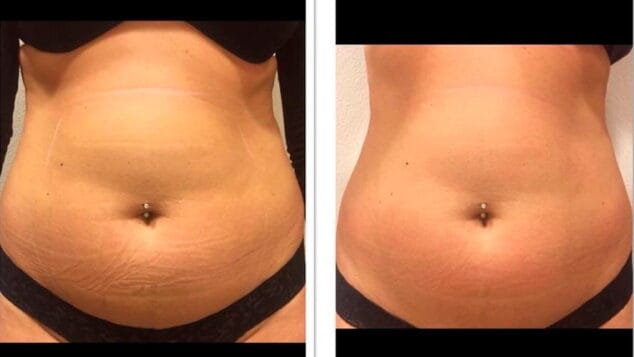 antes y despues ultrasonix dorita e inmna estilistas