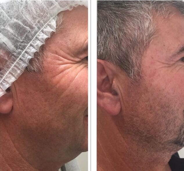 arrugas antes y despues dorita e inma estilistas