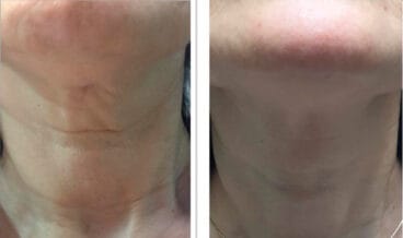 Arrugas cuello Dorita e Inma Estilistas