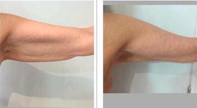 brazo antes y despues del tratamiento ultrasoniz dorita e inma estilistas