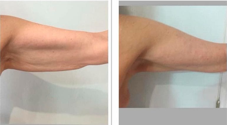 Brazo antes y después del tratamiento Ultrasonix Dorita e Inma Estilistas