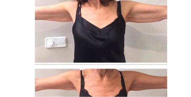 brazos ultrasonix dorita e inma estilistas