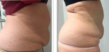 Grasa acumulada después de Ultrasonix Dorita e Inma Estilistas