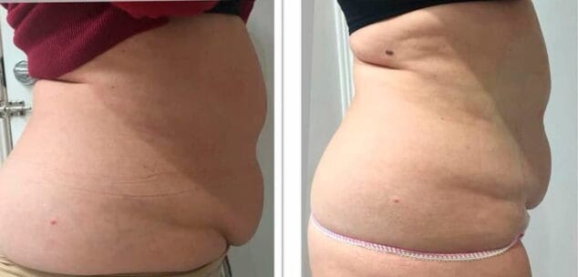 grasa acumulado despues de ultrasonix dorita e inma estilistas