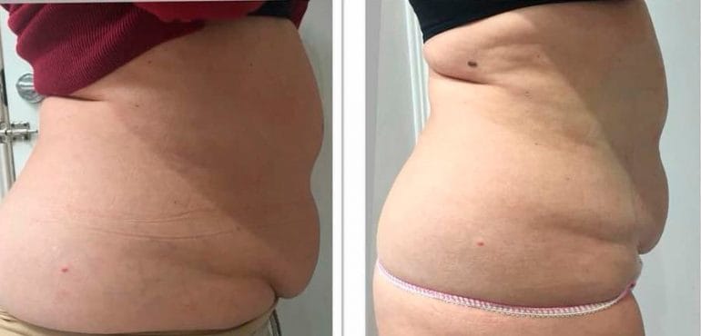 Grasa acumulada después de Ultrasonix Dorita e Inma Estilistas