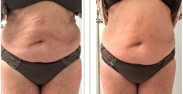 Resultados Ultrasonix Dorita e Inma Estilistas