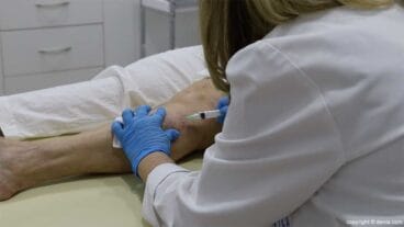 Eliminación varices Clínica Doctora Flores de Apodaca