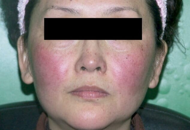 antes de eliminar rojeces ellipse clinica castelblanque