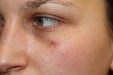 Antes del tratamiento Ellipse – Clínica Castelblanque