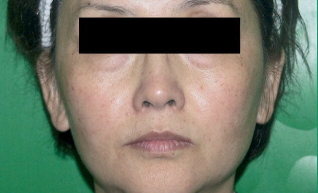 eliminar rojeces clinica castelblanque