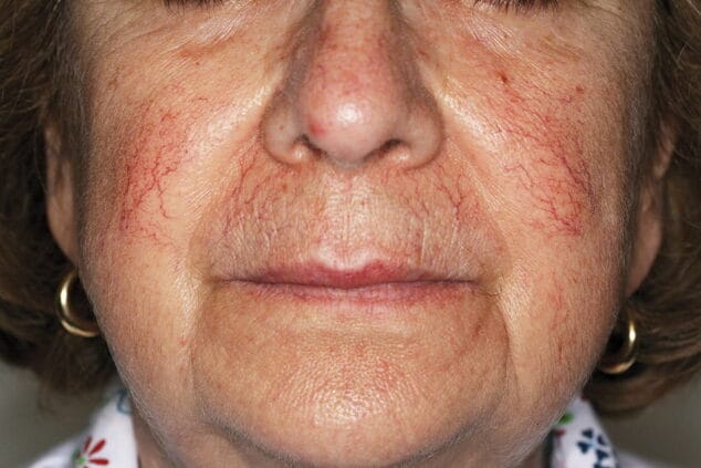 telangiectasias antes cortesia dr simon ellipse castelblanque