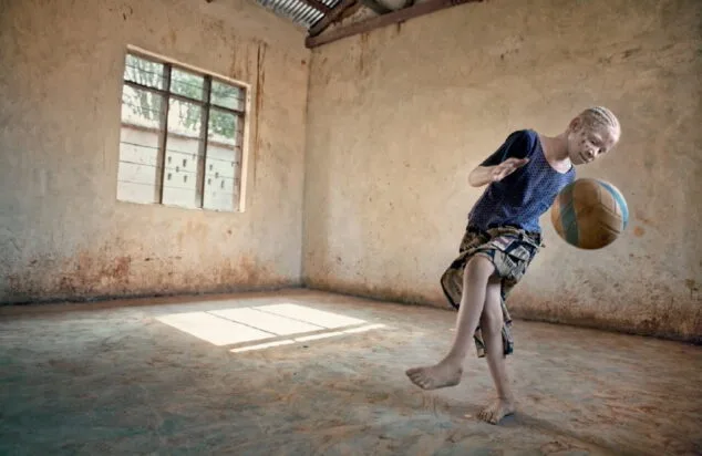 exposicion albino en el hospital de denia