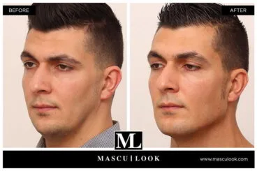 Mascu-look – Clínica Estética Castelblanque