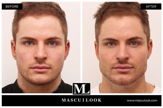 tratamiento acido hialuronico clinica estetica castelblanque