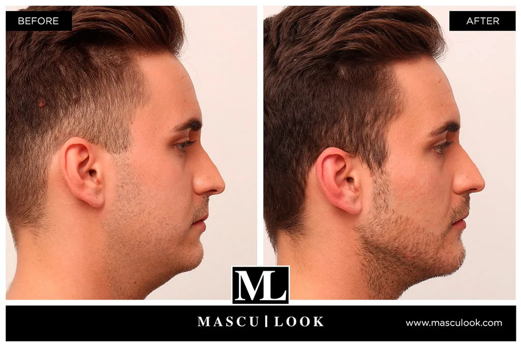 Tratamiento Masculinización – Clínica Estética Castelblanque