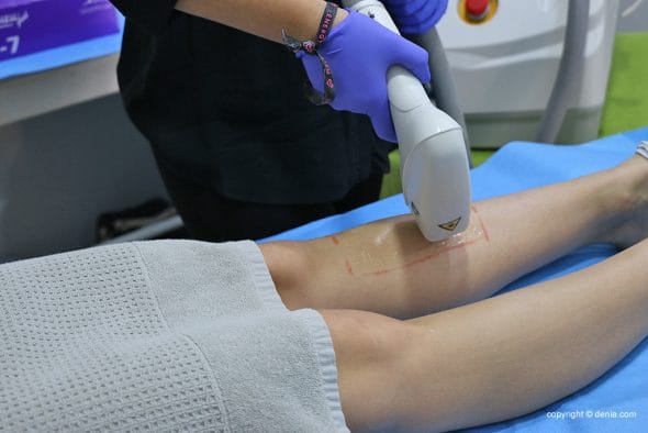 depilacion laser guarana