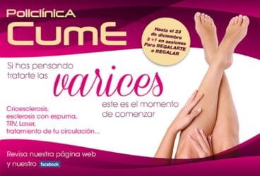 Tratamiento contra las varices con una promoción de 3 + 1 sesiones – Policlínica CUME