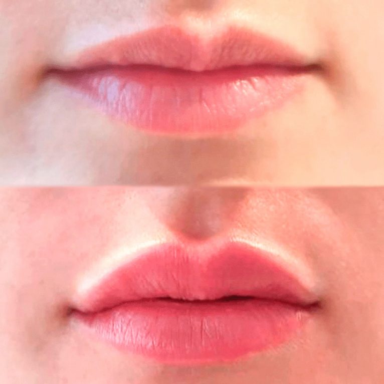 Caso de éxito en un tratamiento de relleno de labios con ácido hialurónico - Clínica Estética Castelblanque