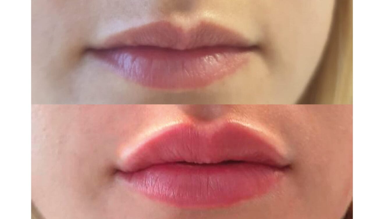 Caso de éxito en un tratamiento de relleno de labios - Clínica Estética Castelblanque